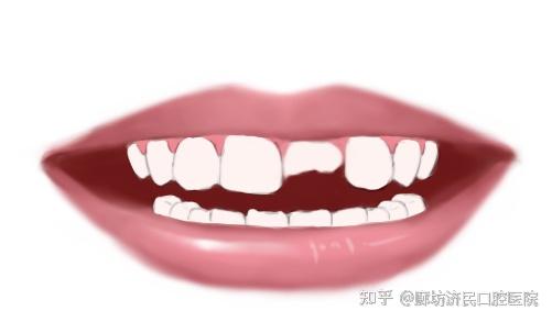 不慎遭遇牙外伤怎么办?别慌!抓住黄金半小时! - 知乎