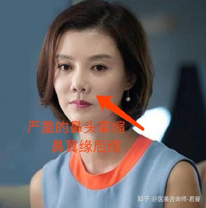 为什么鼻翼不对称? - 知乎