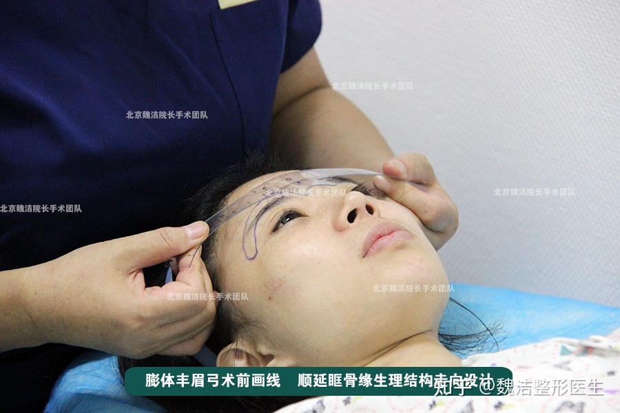 膨体眉弓假体雕刻的核心需尊重眉骨生理结构、契合美学规律 呈现弧度弯曲顺延眶骨缘 北京魏洁 - 知乎
