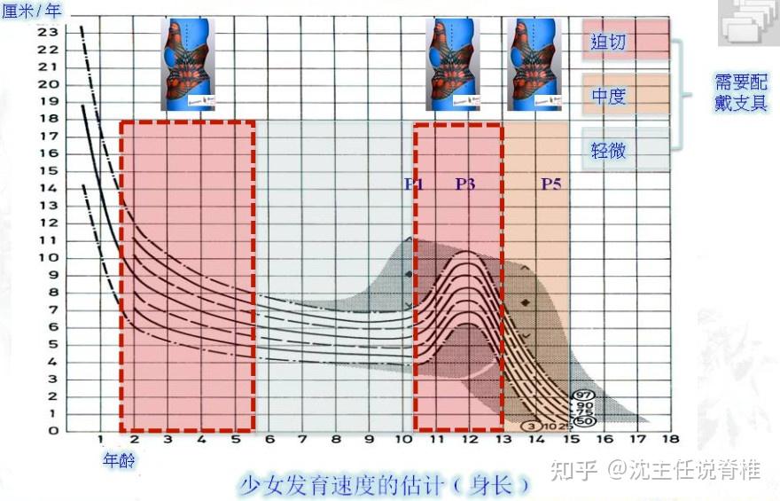 脊柱侧弯厘米对照表图片