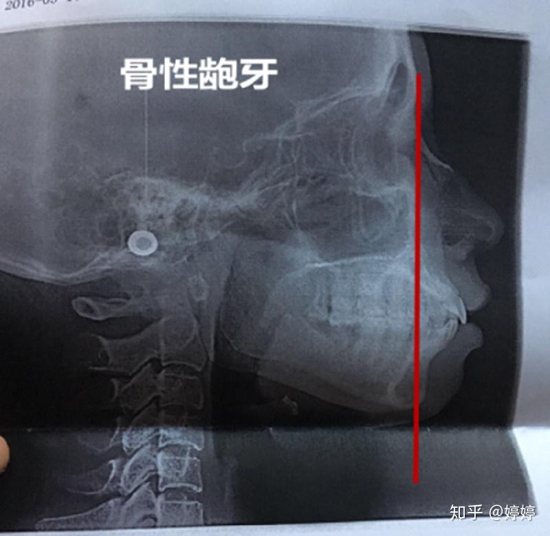 下颌骨ct平扫图片