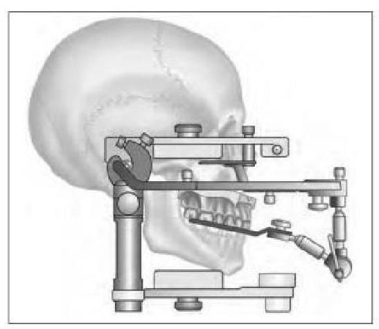 一个口腔修复学博士级的问题:髁导斜度,切道斜度,切导斜度