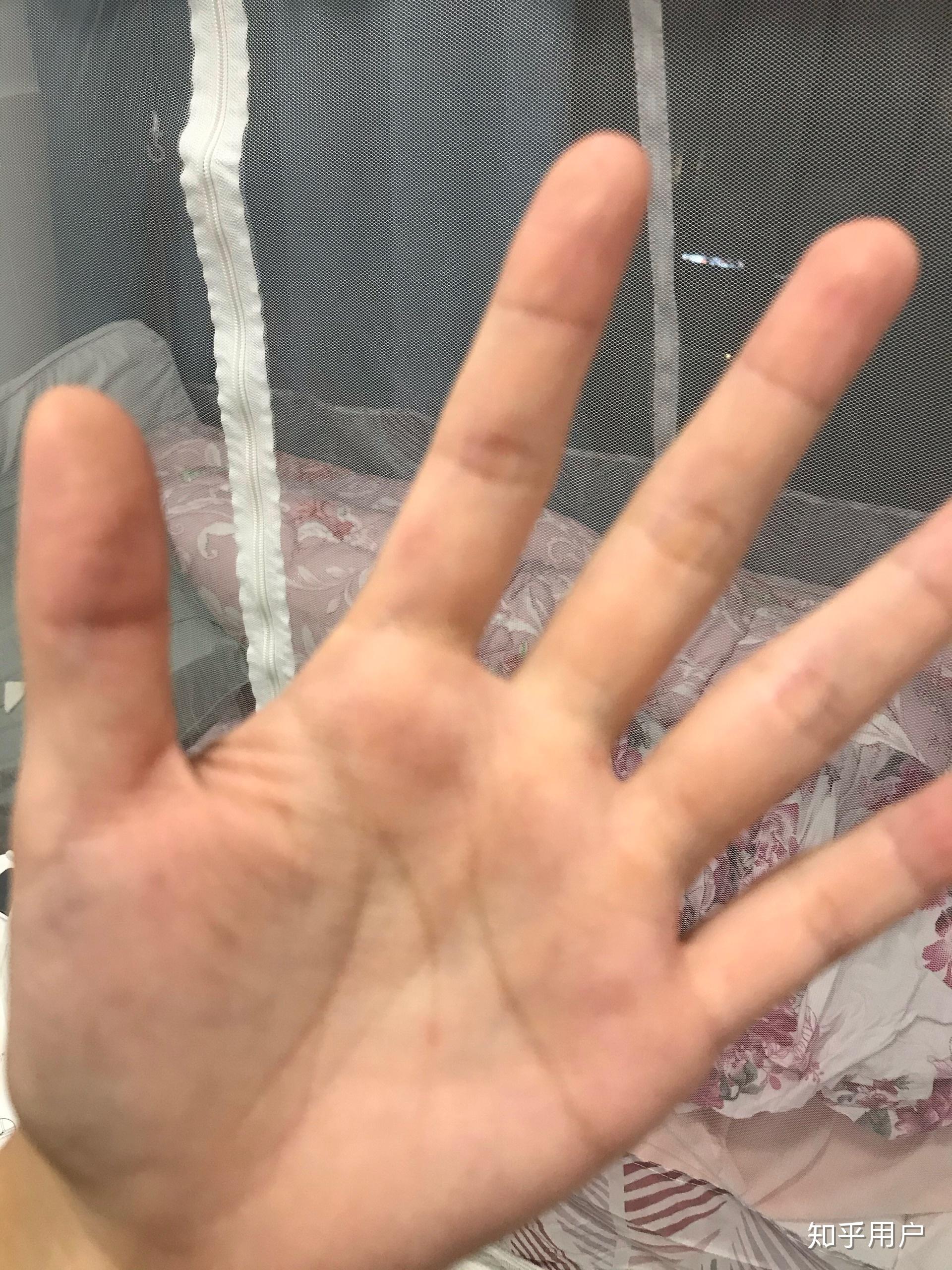 玻璃纤维会刺入皮肤吗有什么危害