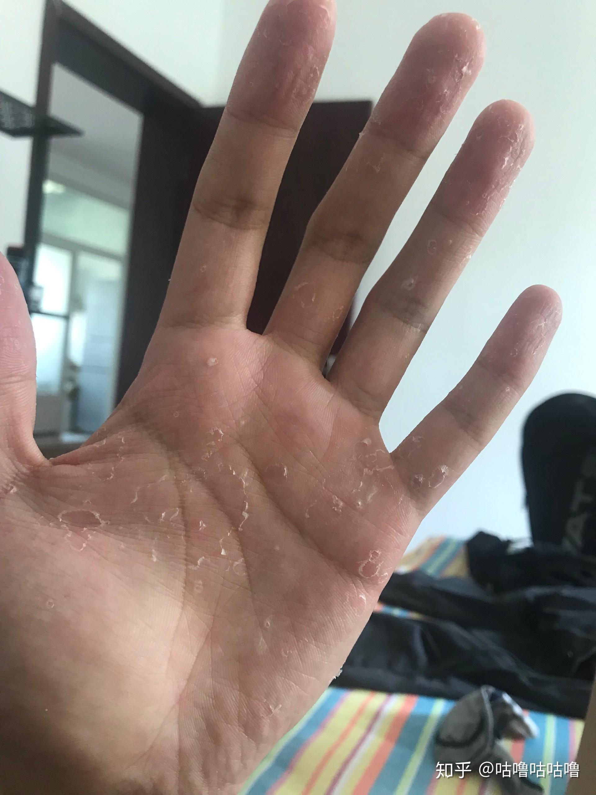 手上蜕皮怎么回事看图片求原因和治疗方案