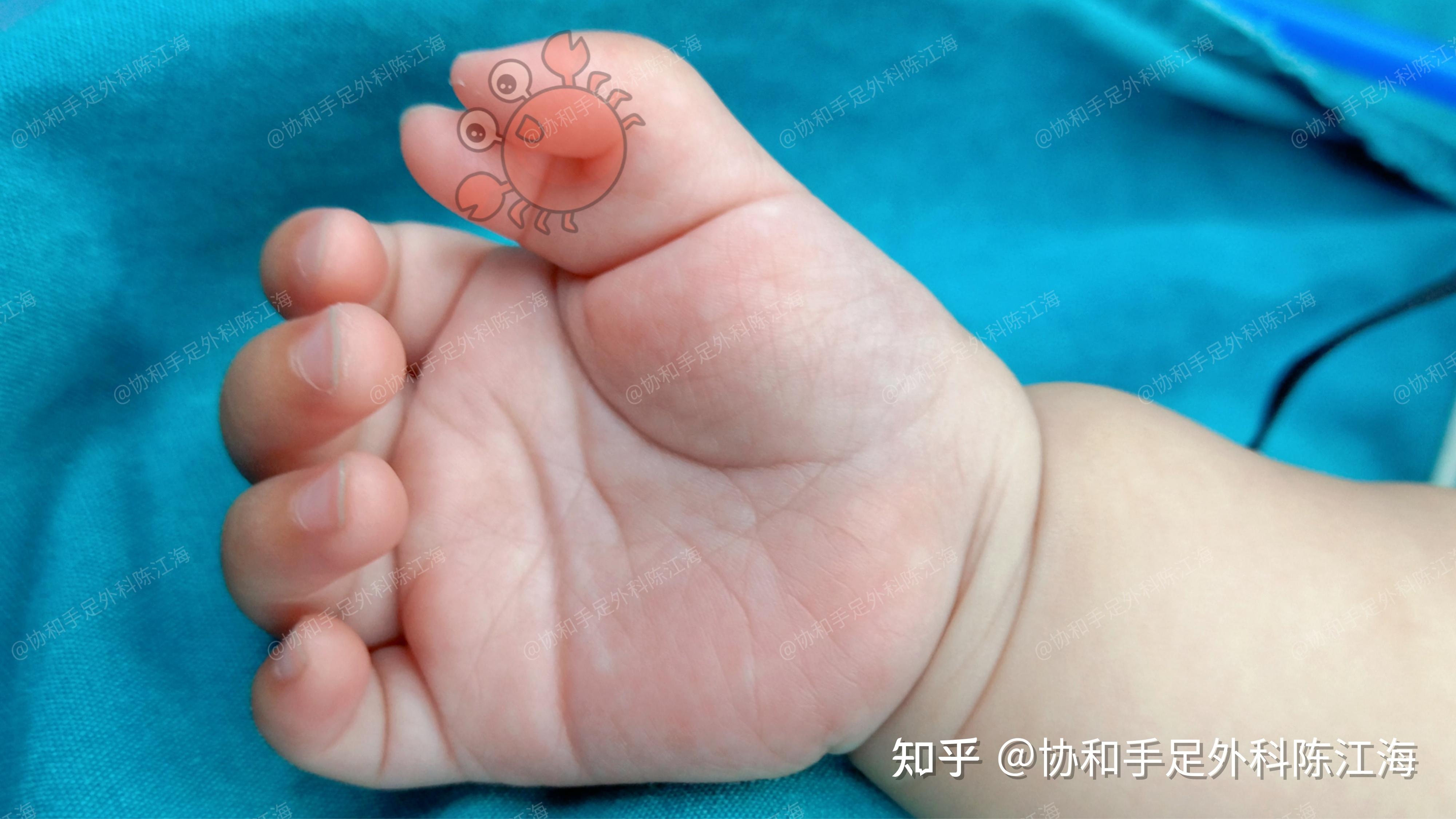 多指畸形有哪些治疗方法? - 知乎