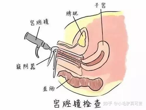 宫腔粘连有哪些表现?致病原因是什么?该如何预防和治疗呢?