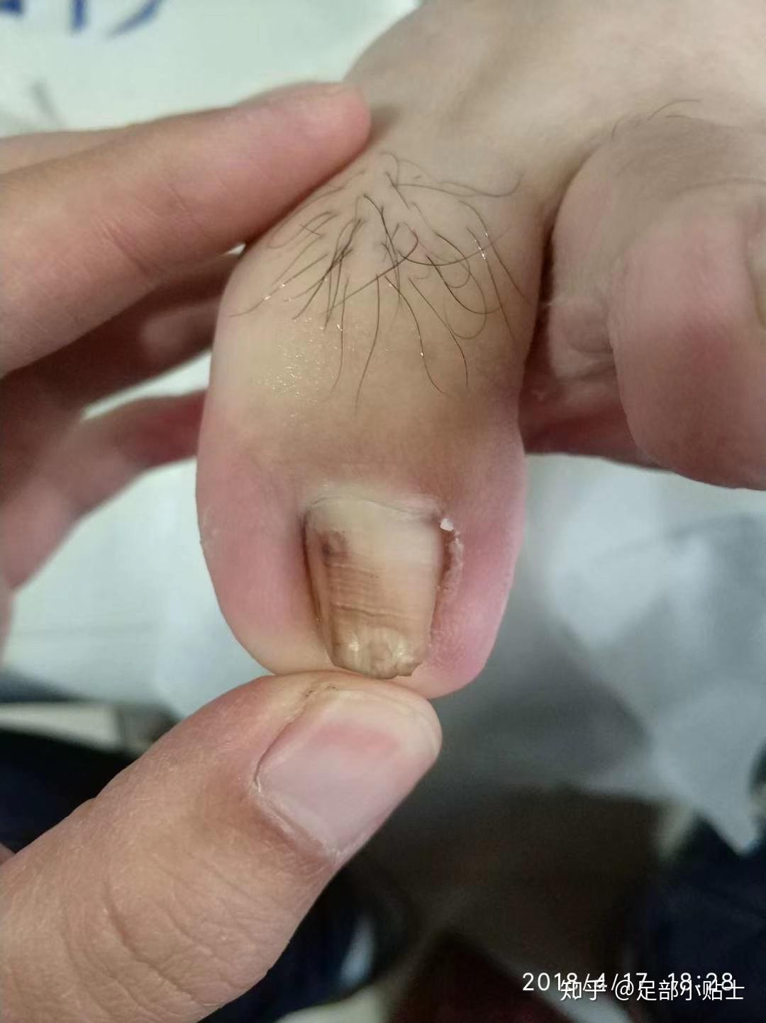 我的脚趾甲长得一直往肉里面进每次走路都难受我该怎么办呢