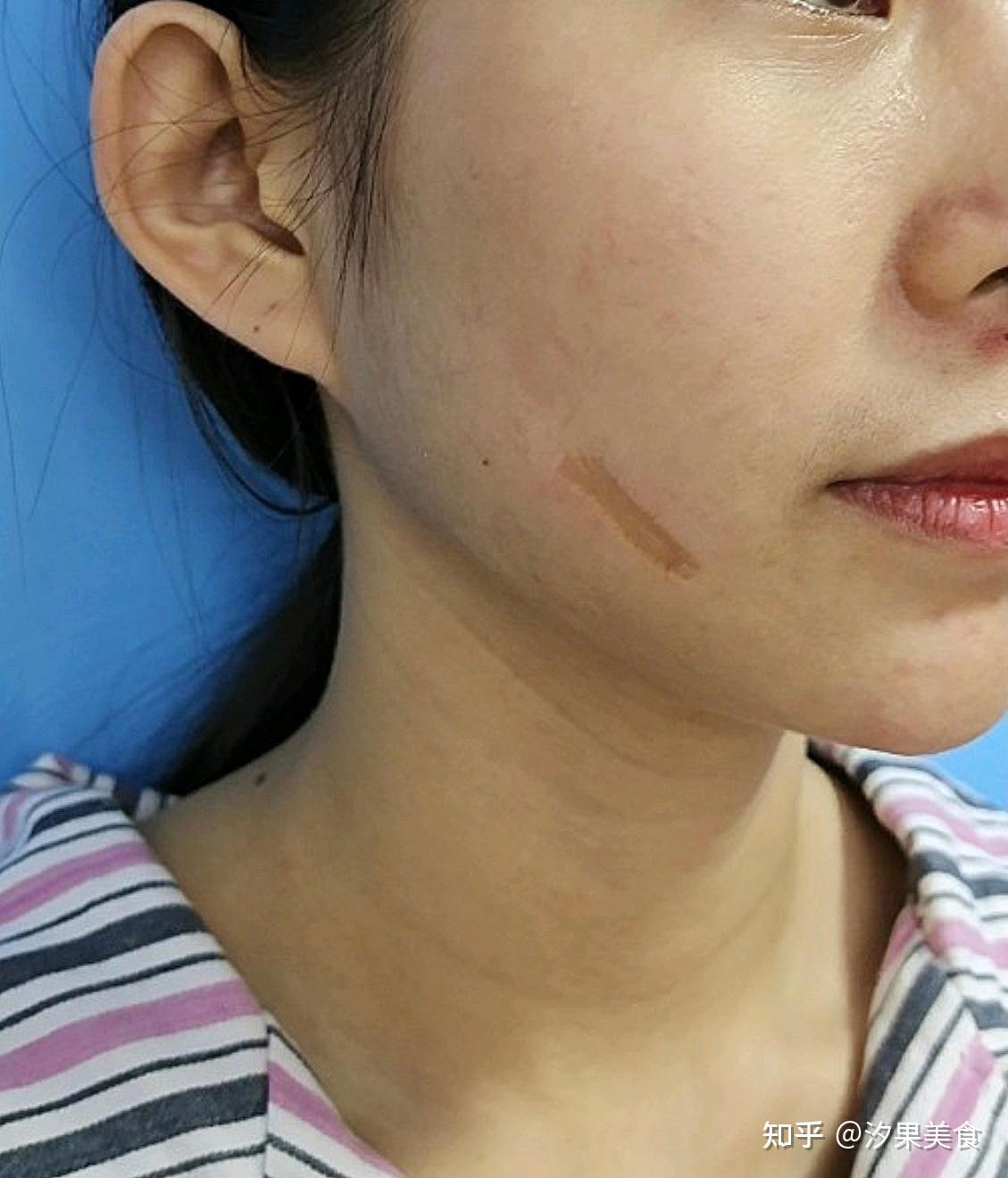 面部疤痕修复案例（二）_美容