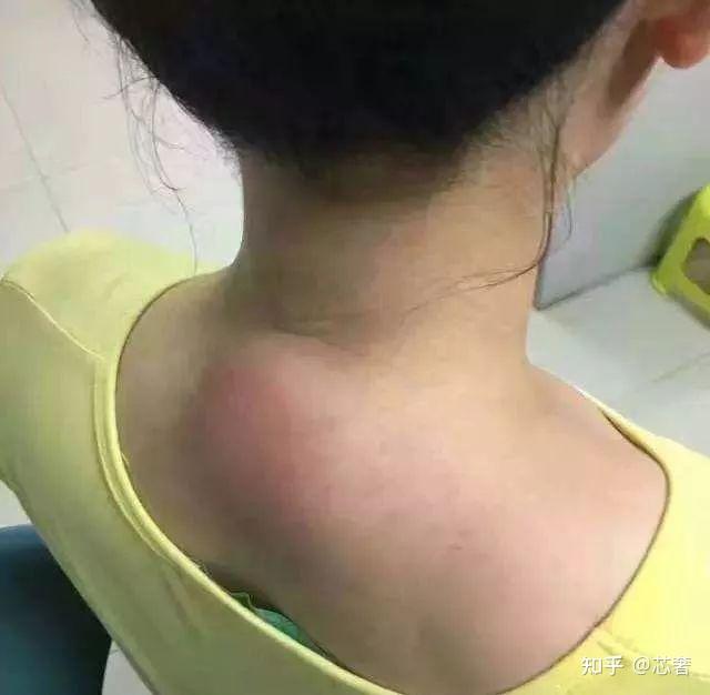 后颈植发后(植发后颈部淋巴结肿大疼痛)