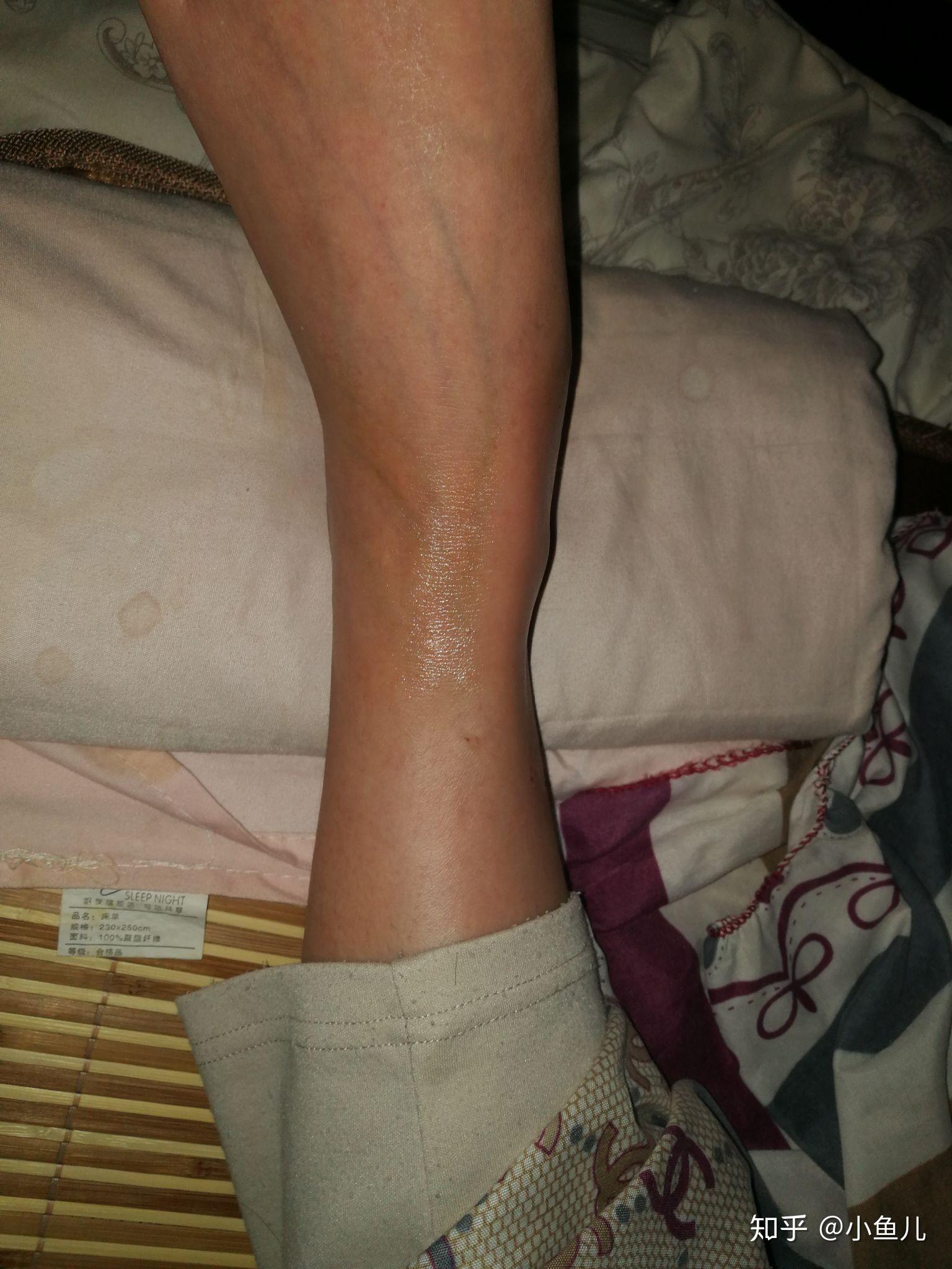 脚崴了伤到筋,4个月都没好? - 知乎