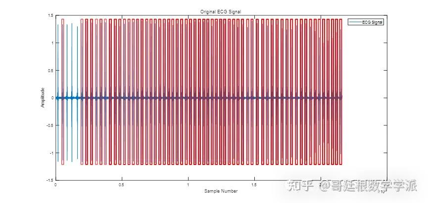 心电图v1导联呈rs波,具体的r波代表什么?