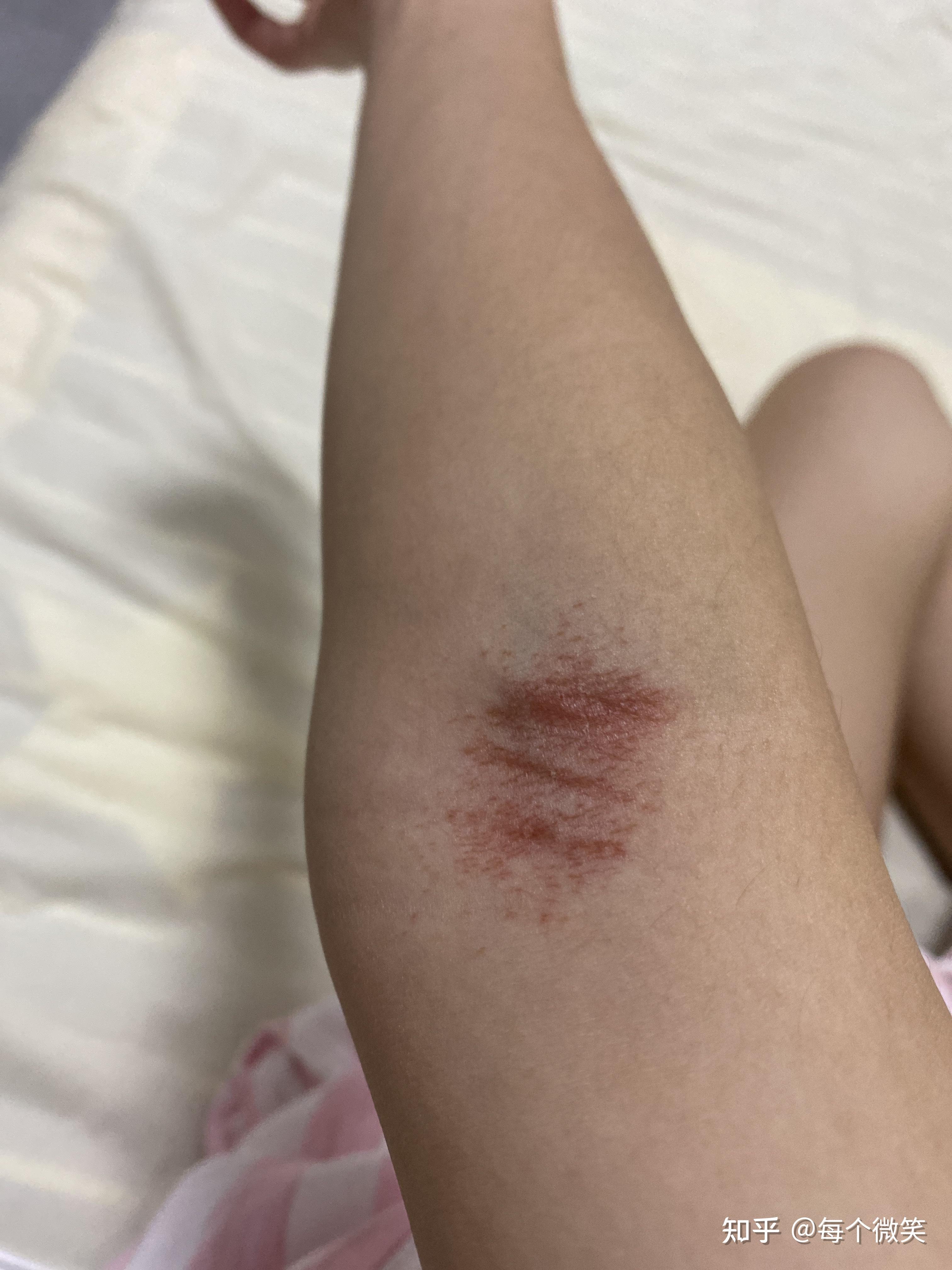 手肘内侧红一片是什么原因?