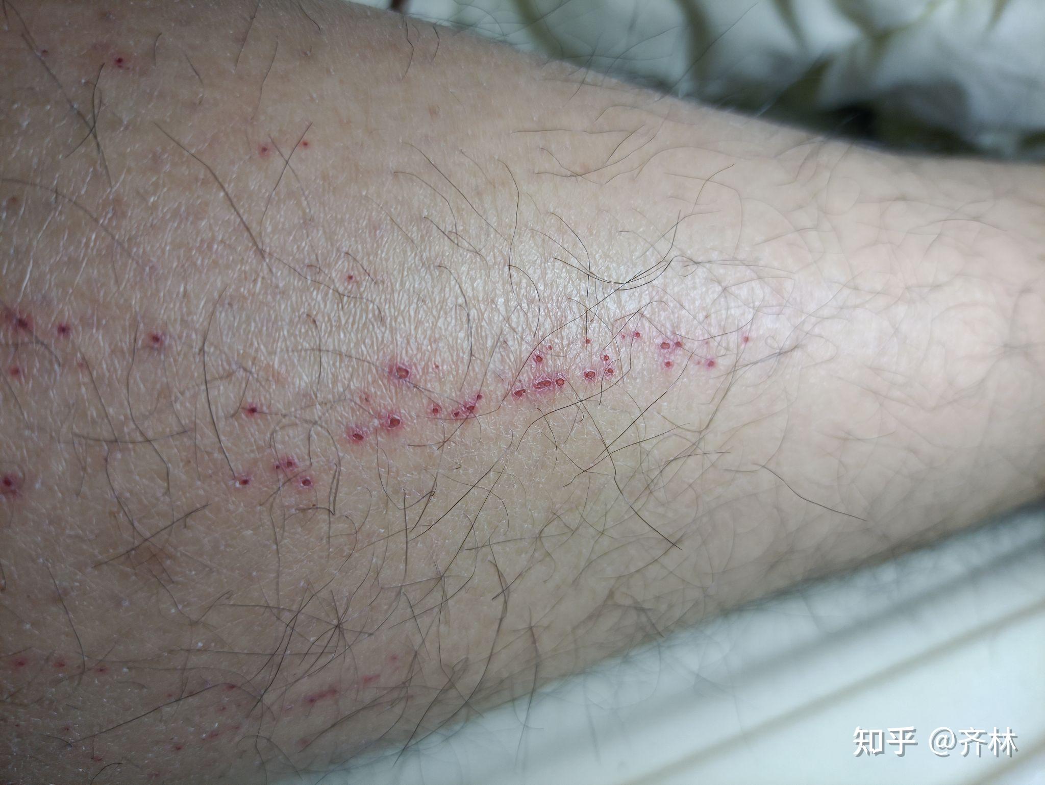 腿上有这种小红点怎么回事? - 知乎