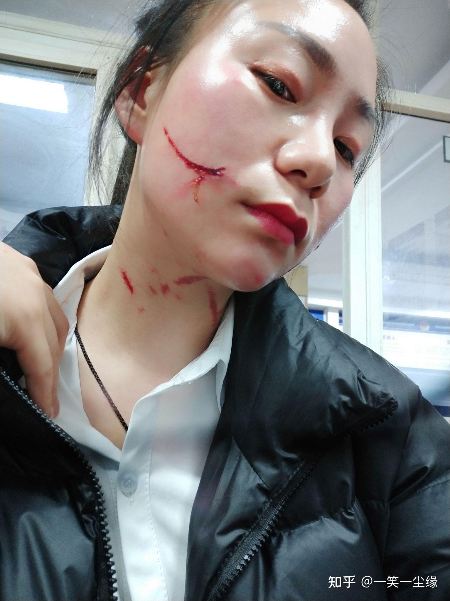 脸上被人抓了 刮掉几块肉 怎么处理才能快速痊愈且不留疤痕? - 知乎