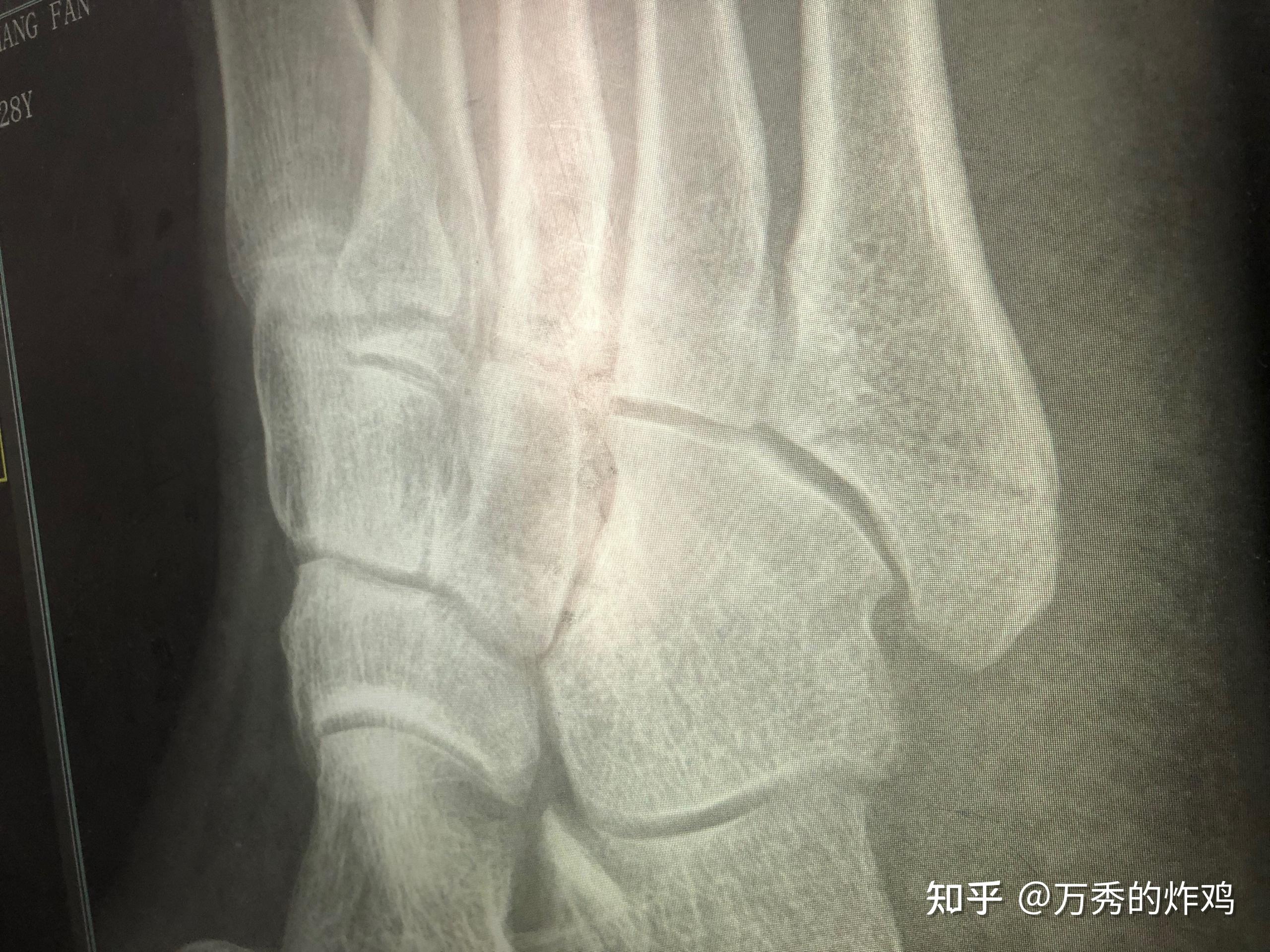 第五跖骨骨折多长时间能走路