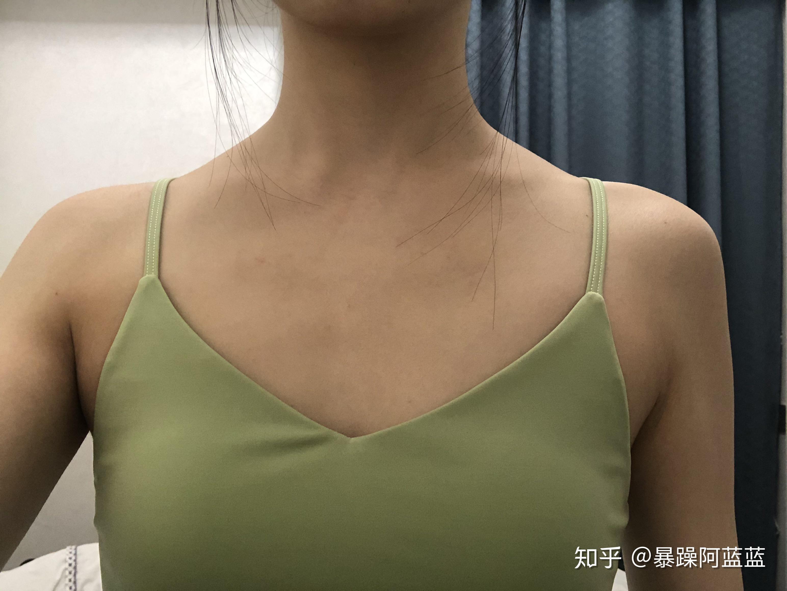 一个人没有或几乎没有锁骨是怎样一种体验