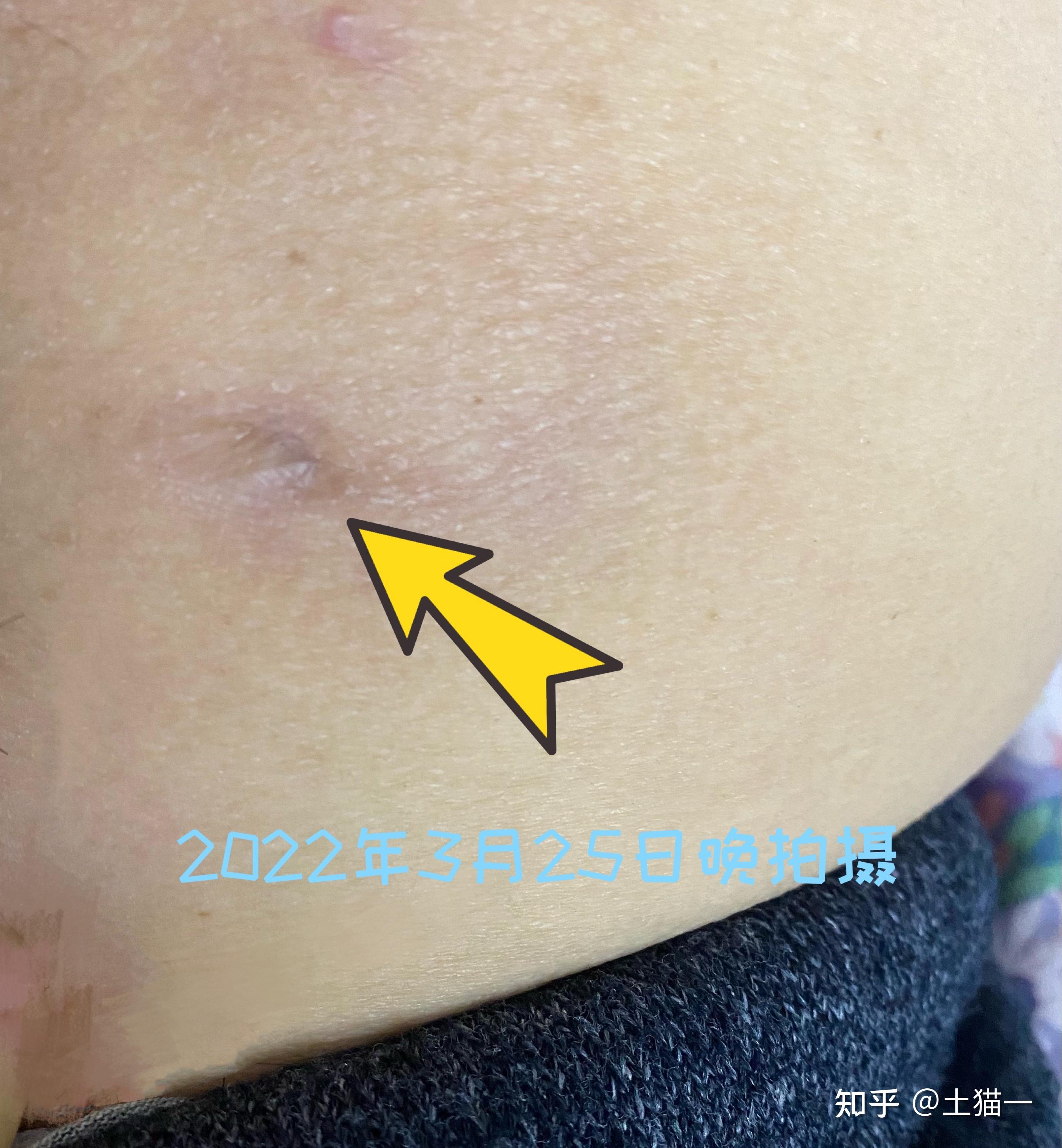 坐板疮 怎么治疗呢?已经好长时间了 - 知乎