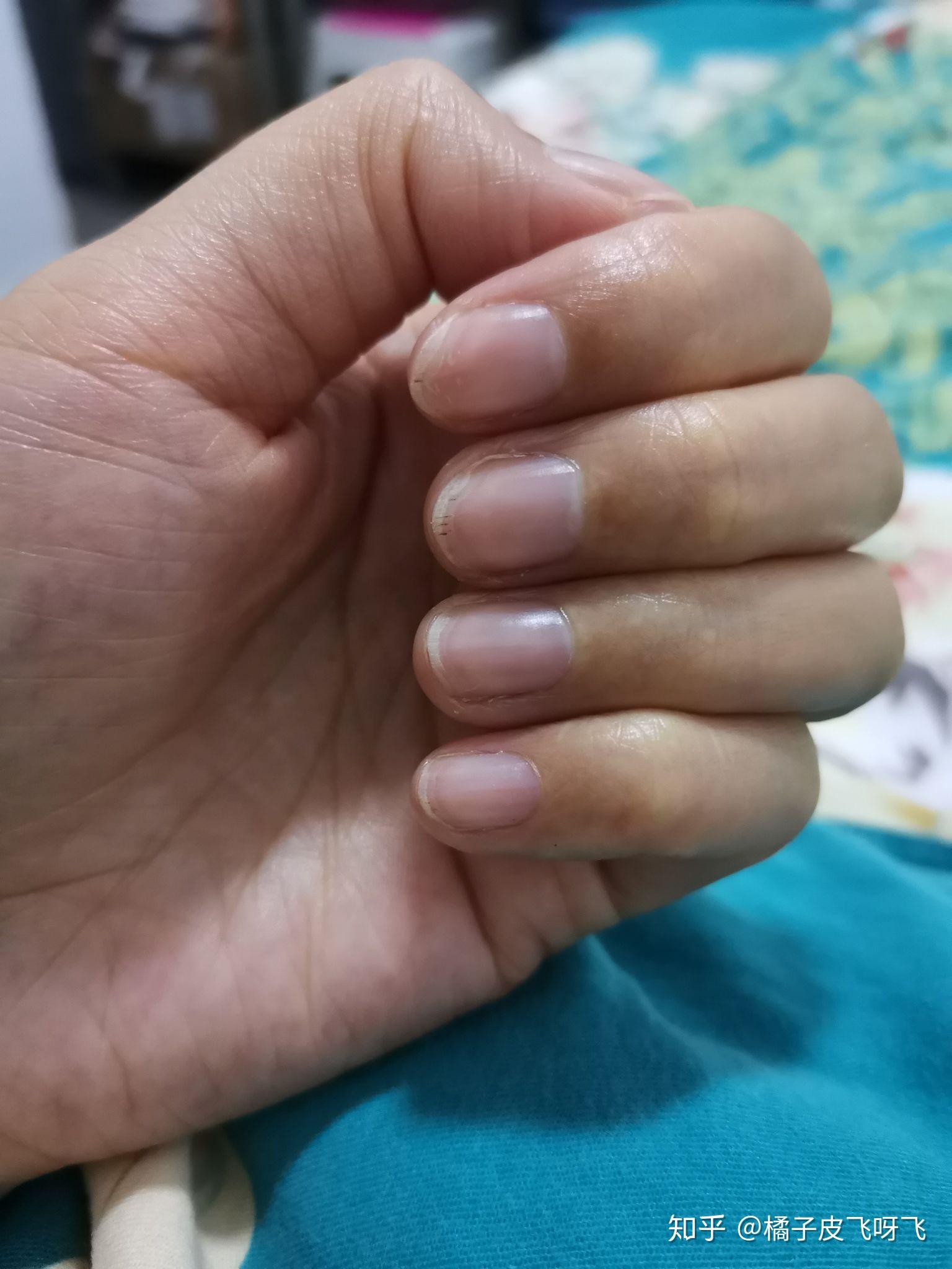 手指甲有褐色短血丝怎么回事