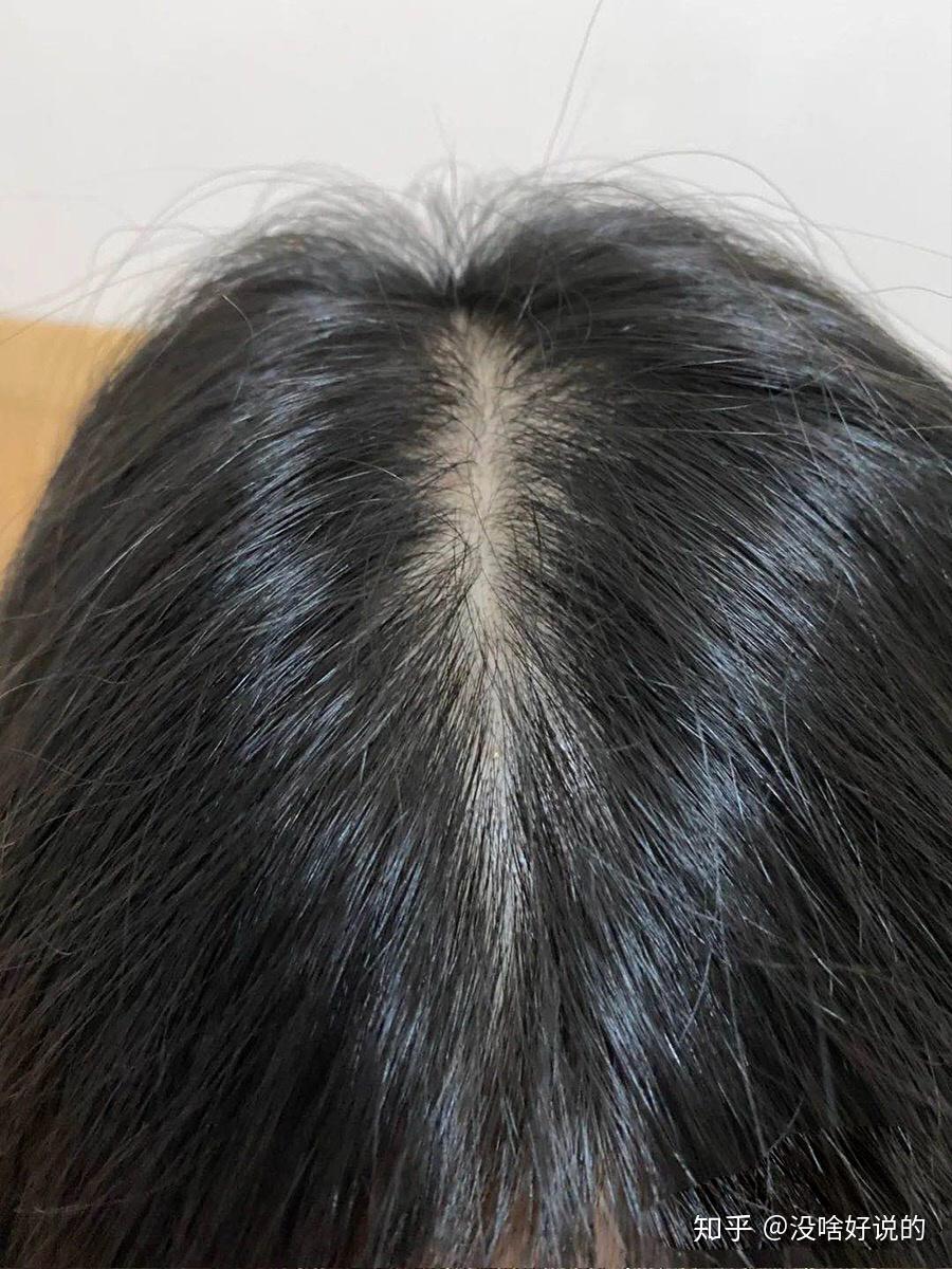 女生头发稀少怎么办