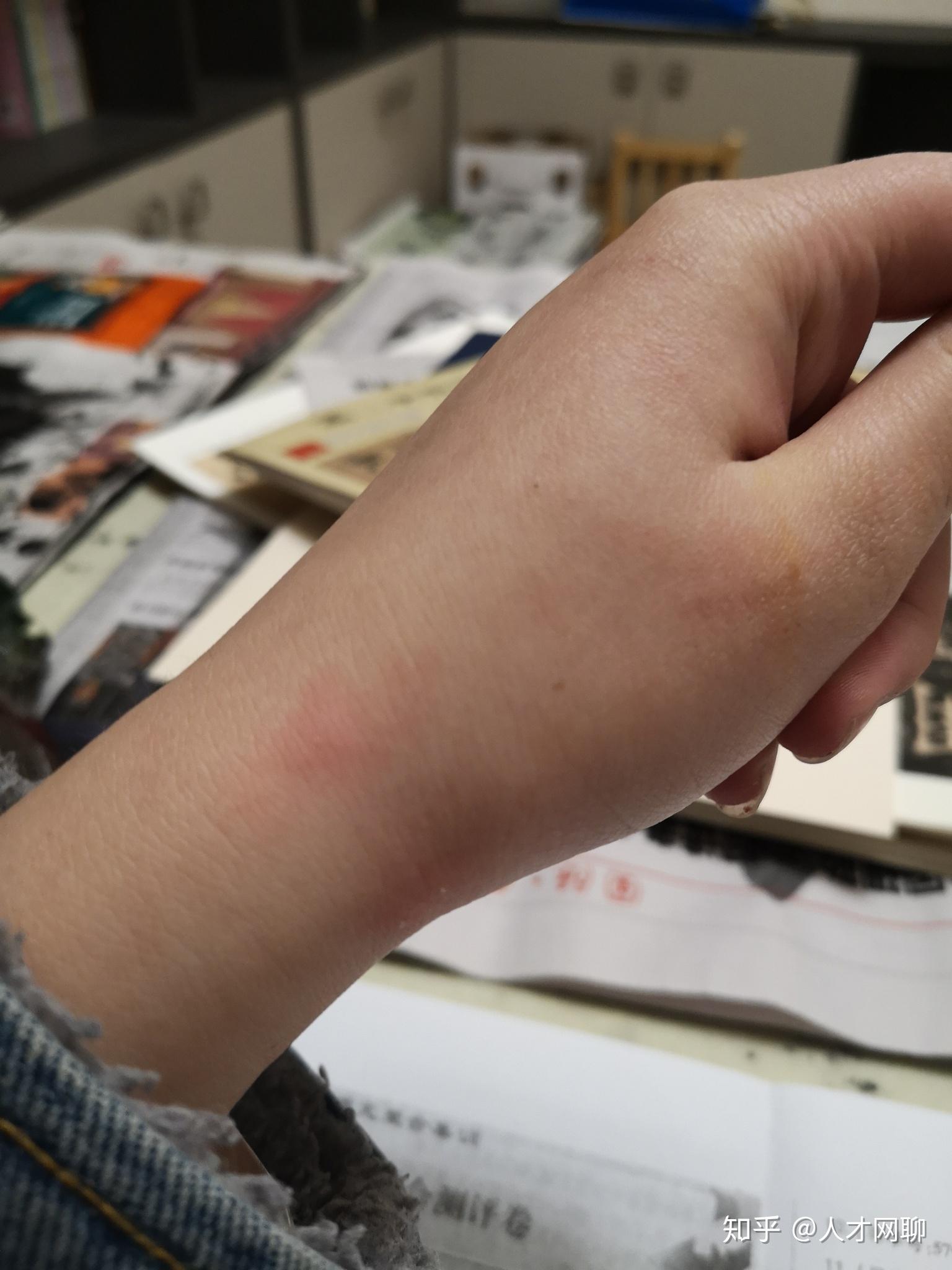 被家养的兔子抓伤了手,破了皮,发现时没流血,要打疫苗吗? - 知乎