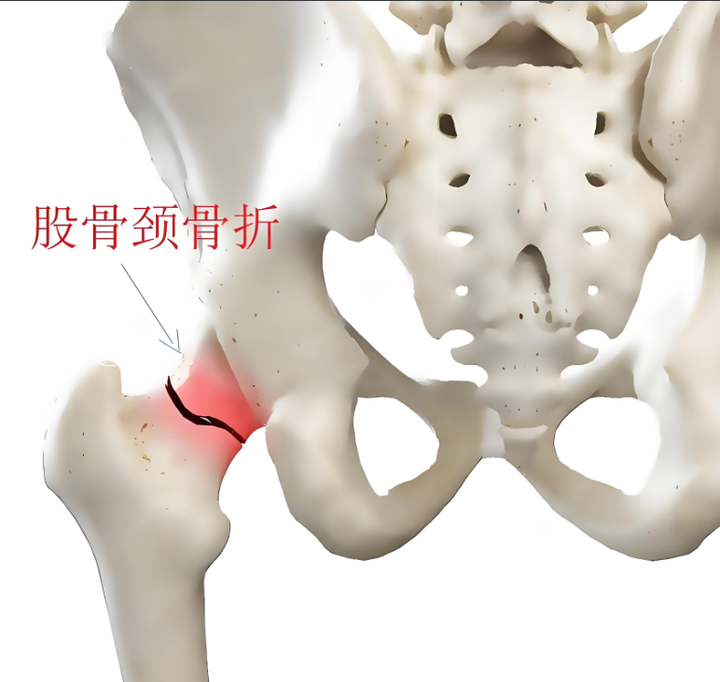 交通事故造成股骨颈骨折伤残等级能评多少?怎么赔偿?