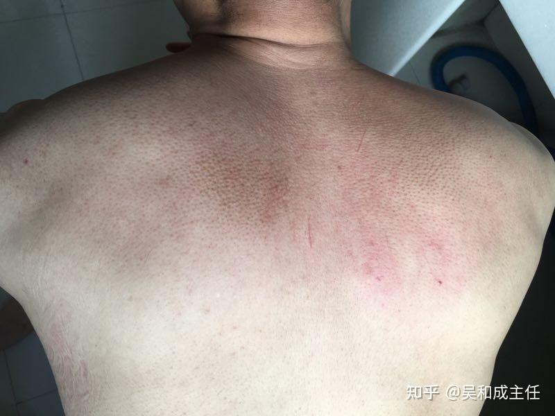 黑棘皮病如何治疗