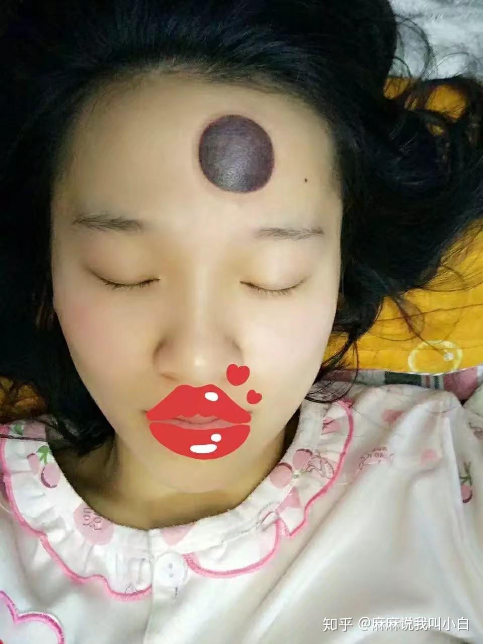 女人额头拔火罐图片