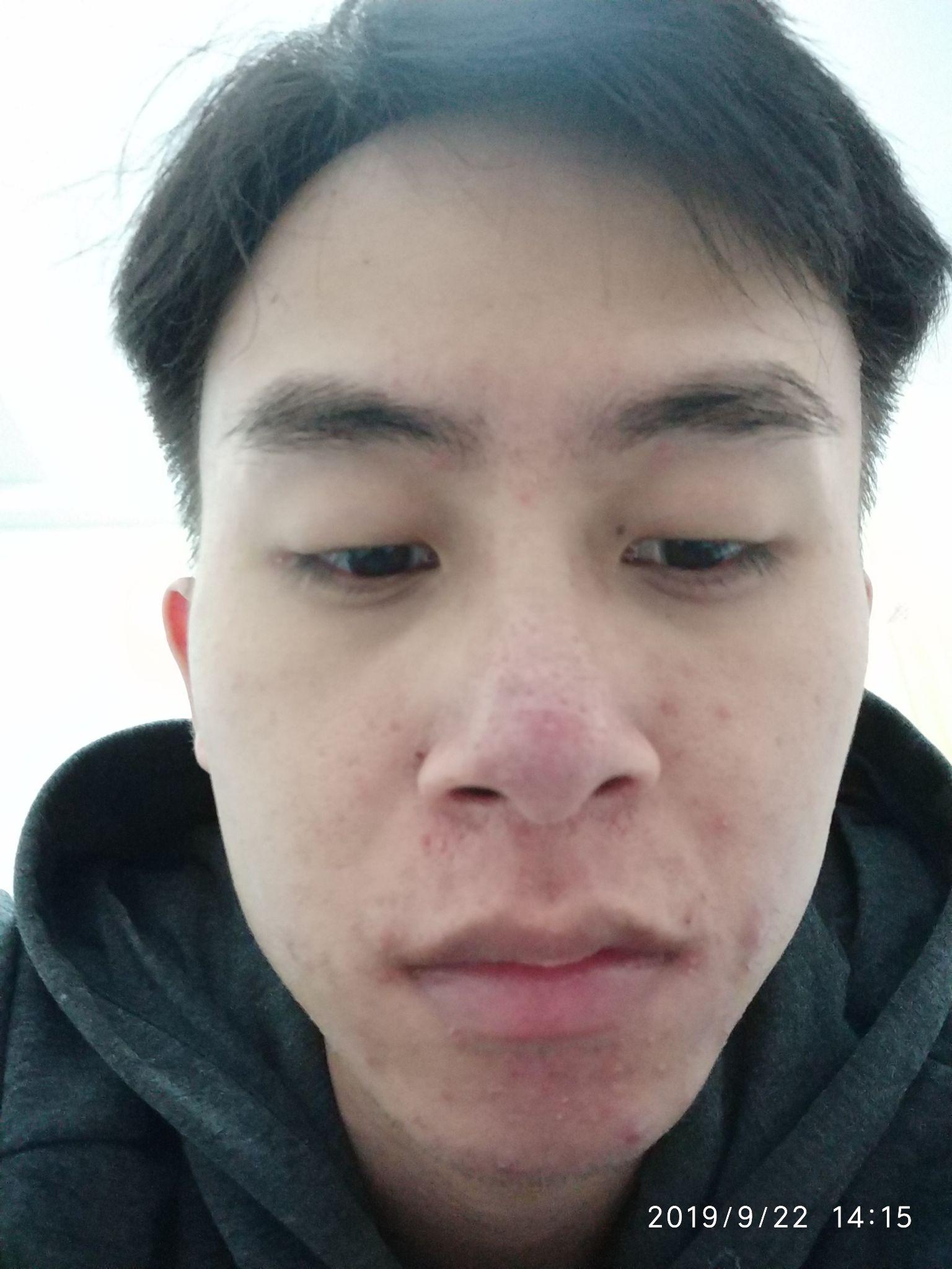 我是一个酒糟鼻患者,有没有大神告诉我酒糟鼻应该怎么治疗,谢谢.? - 