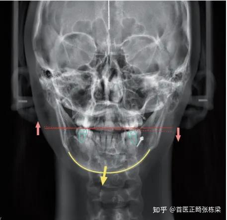 偏颌什么程度才要正颌手术? - 知乎