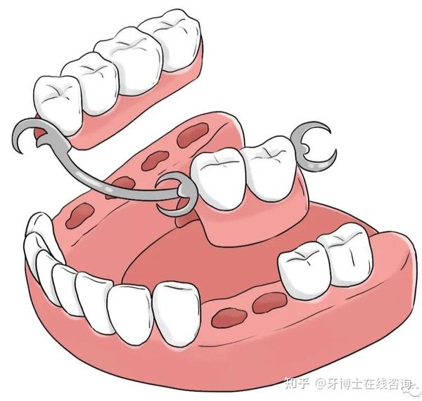 一,缺牙修復的方式有哪些?