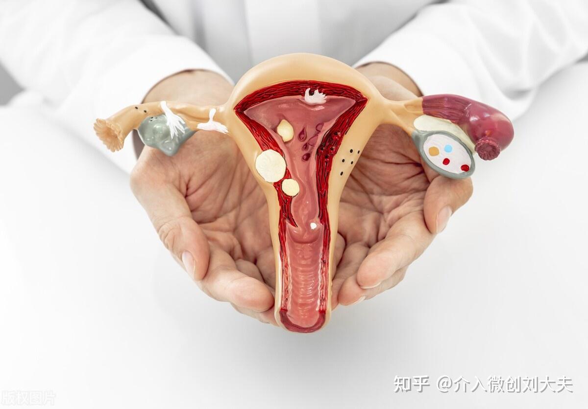 切除子宫和卵巢会对女人产生什么影响? 
