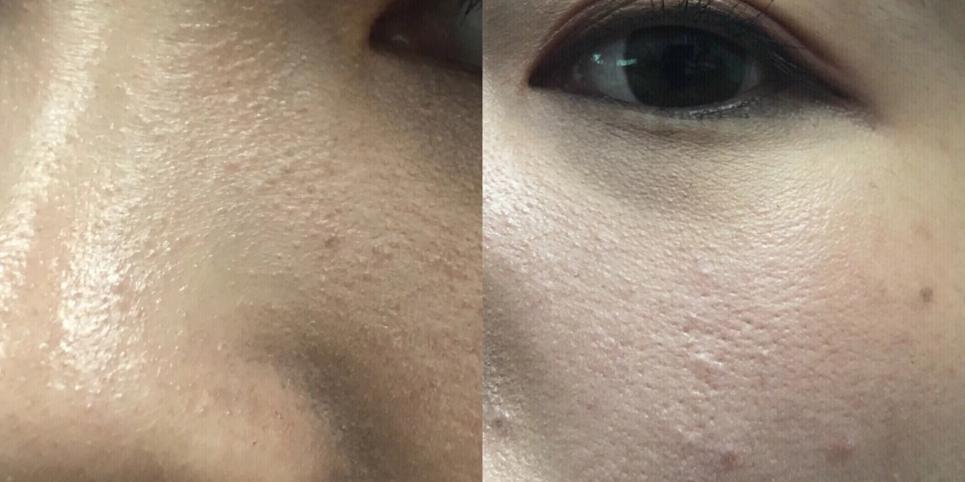 脸部毛周角化症怎么破? - 知乎