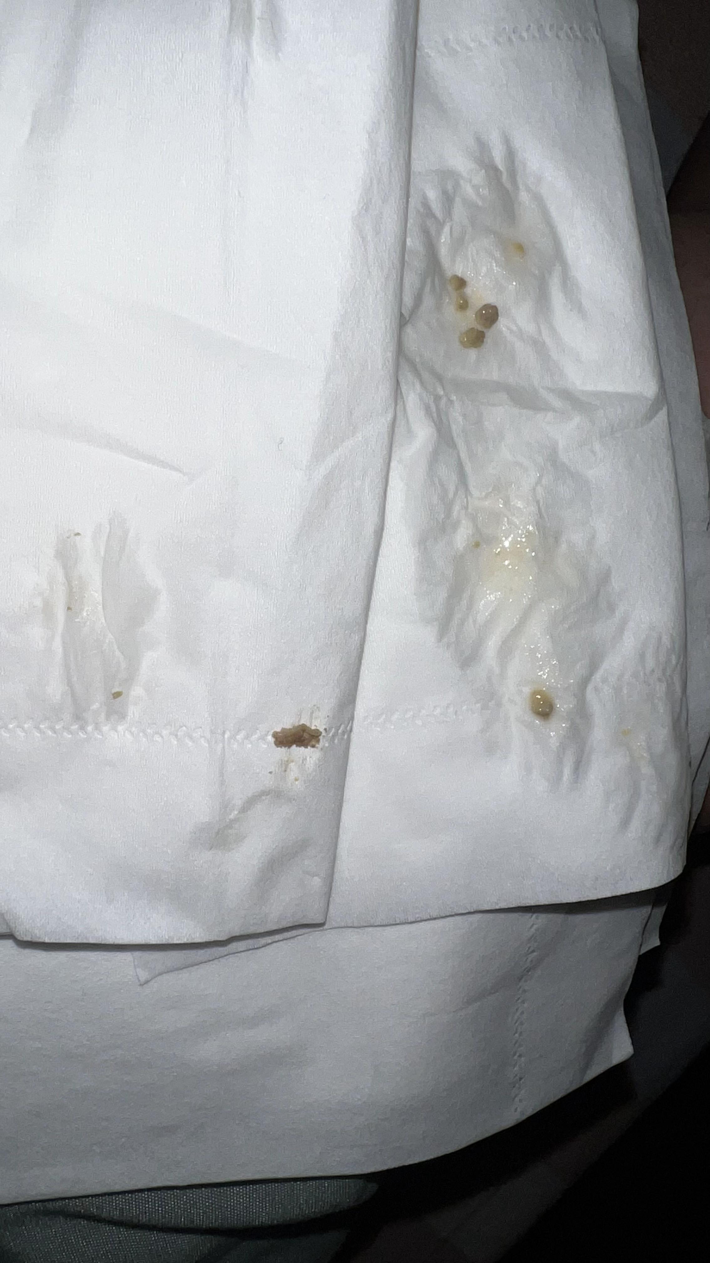 你见过最大的扁桃体结石有多大?