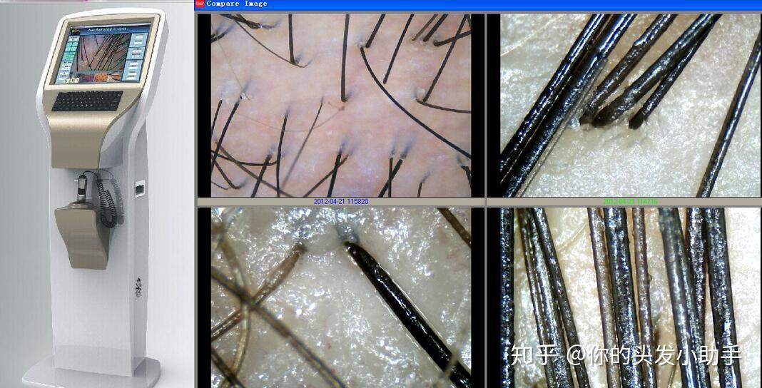 毛囊坏死是什么样子的? - 知乎