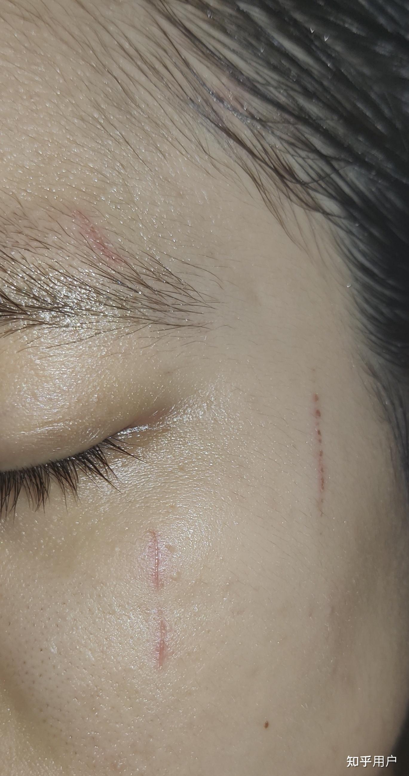 脸被猫抓伤,如何护理不会落疤或印痕? - 知乎