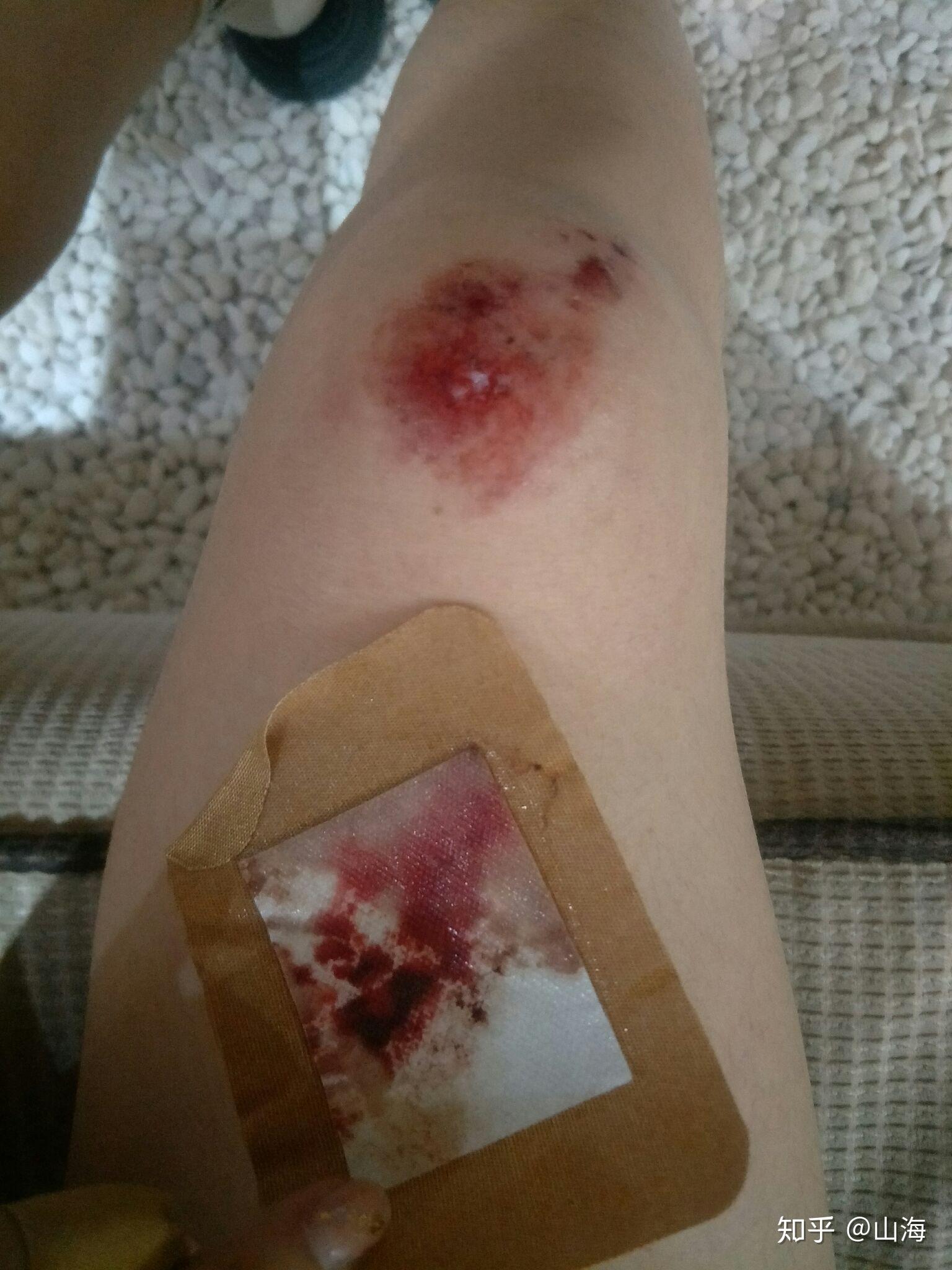 膝盖摔伤图片真实流血图片