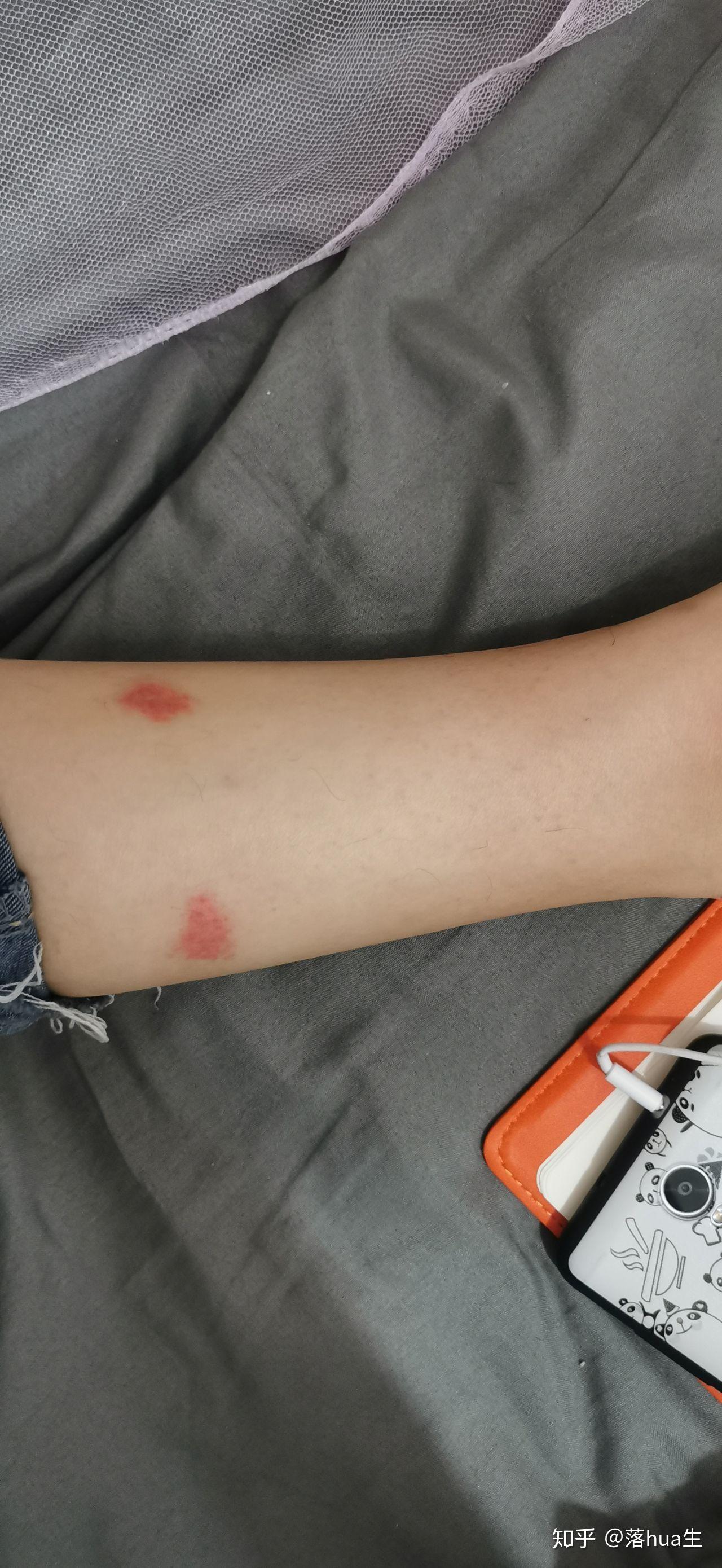 为什么我被蚊子咬了之后皮肤会变成类似淤青的紫红色消退的很慢肿的