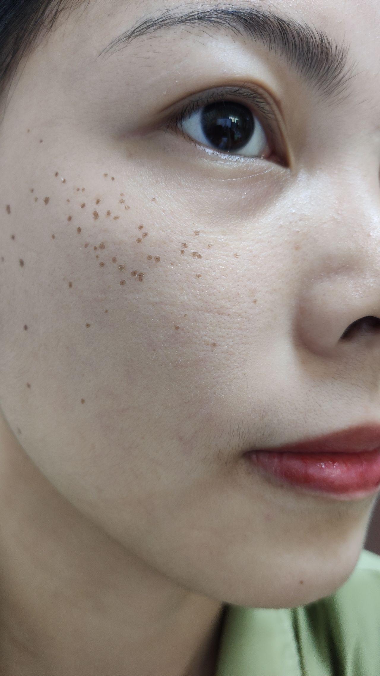 点斑后的恢复期? - 知乎