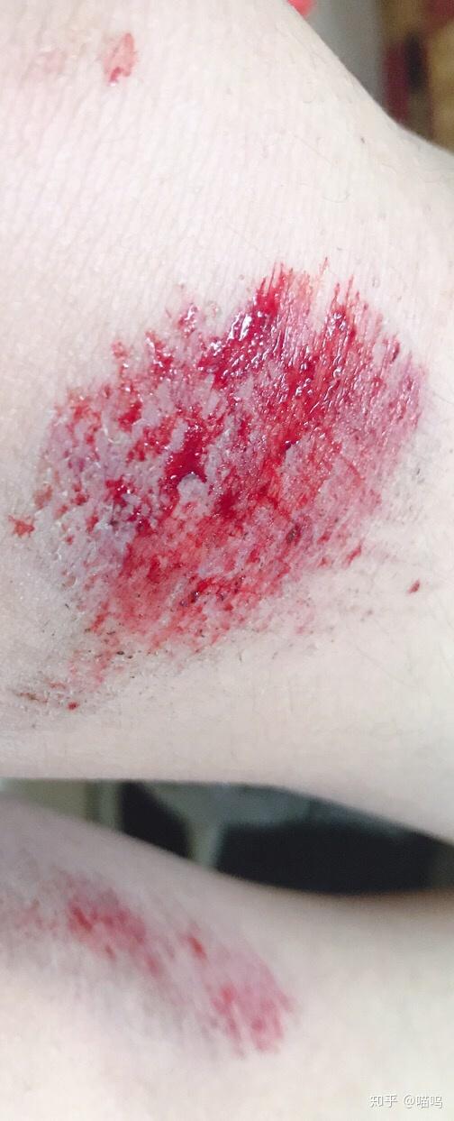 膝盖摔伤,抹了碘伏结痂后如何防止留疤?