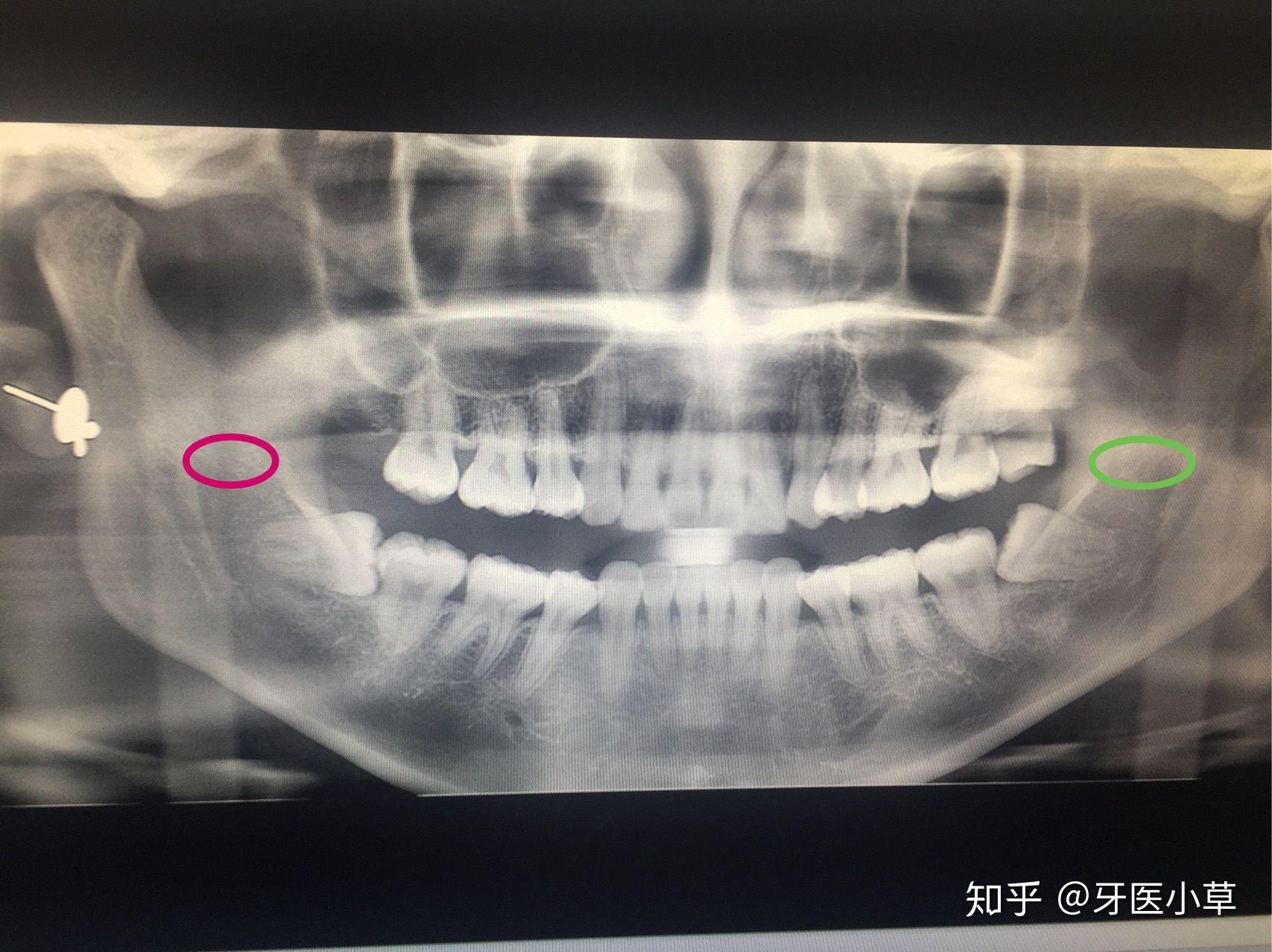 口腔x光片怎么分左右