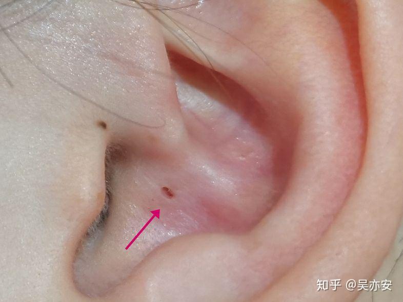 请问你们耳朵壁会长黑头吗?一颗一颗的黑的? - 知乎