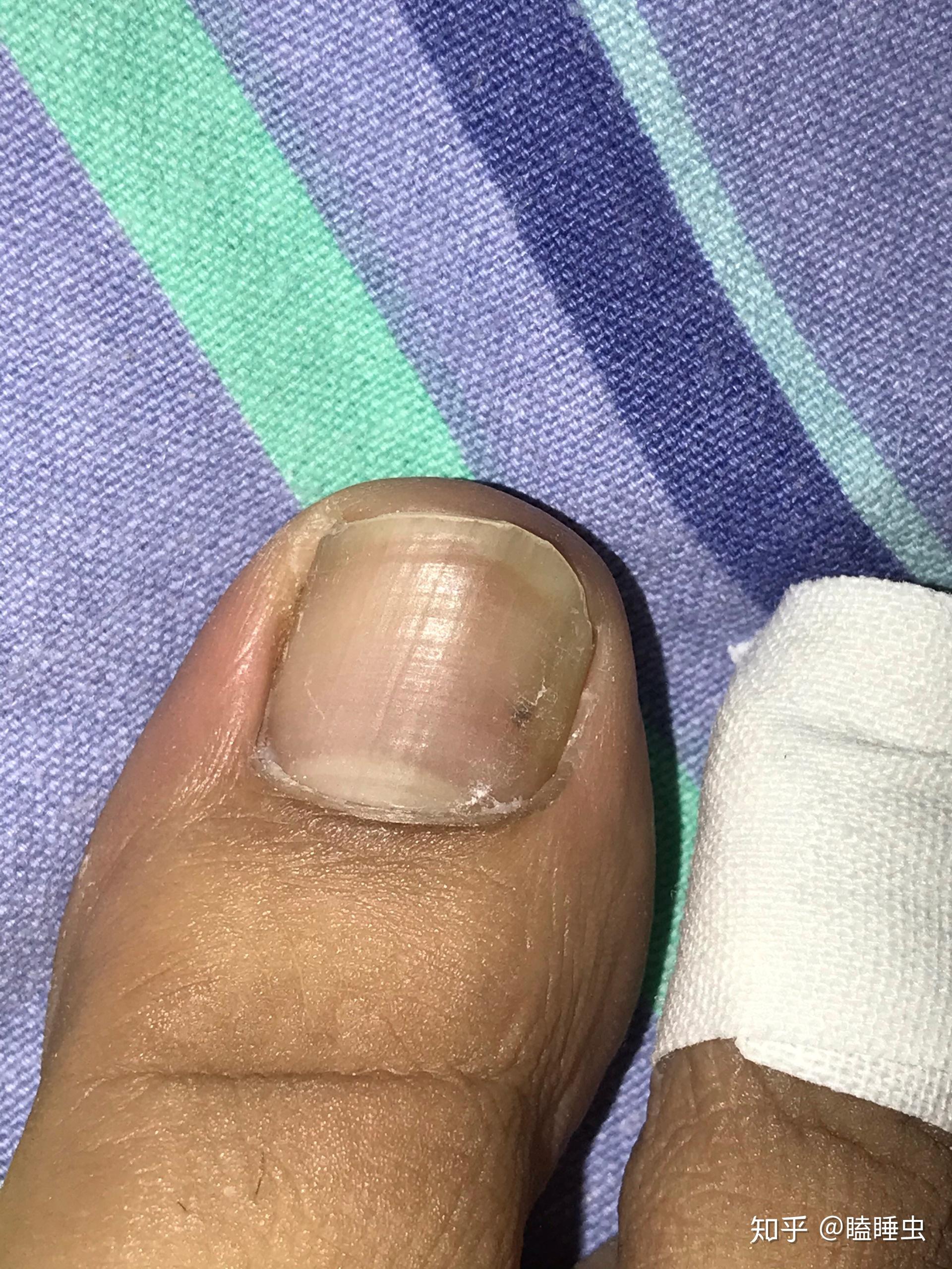 指甲下面的黑点