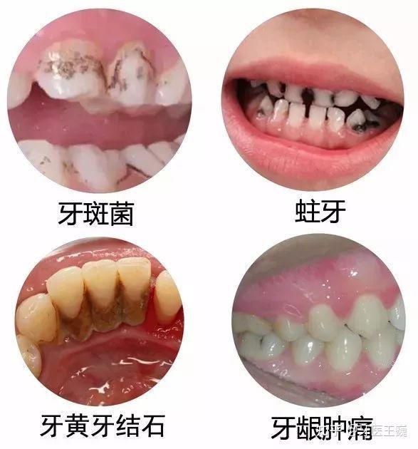 為什麼牙結石多的地方蟲牙很少