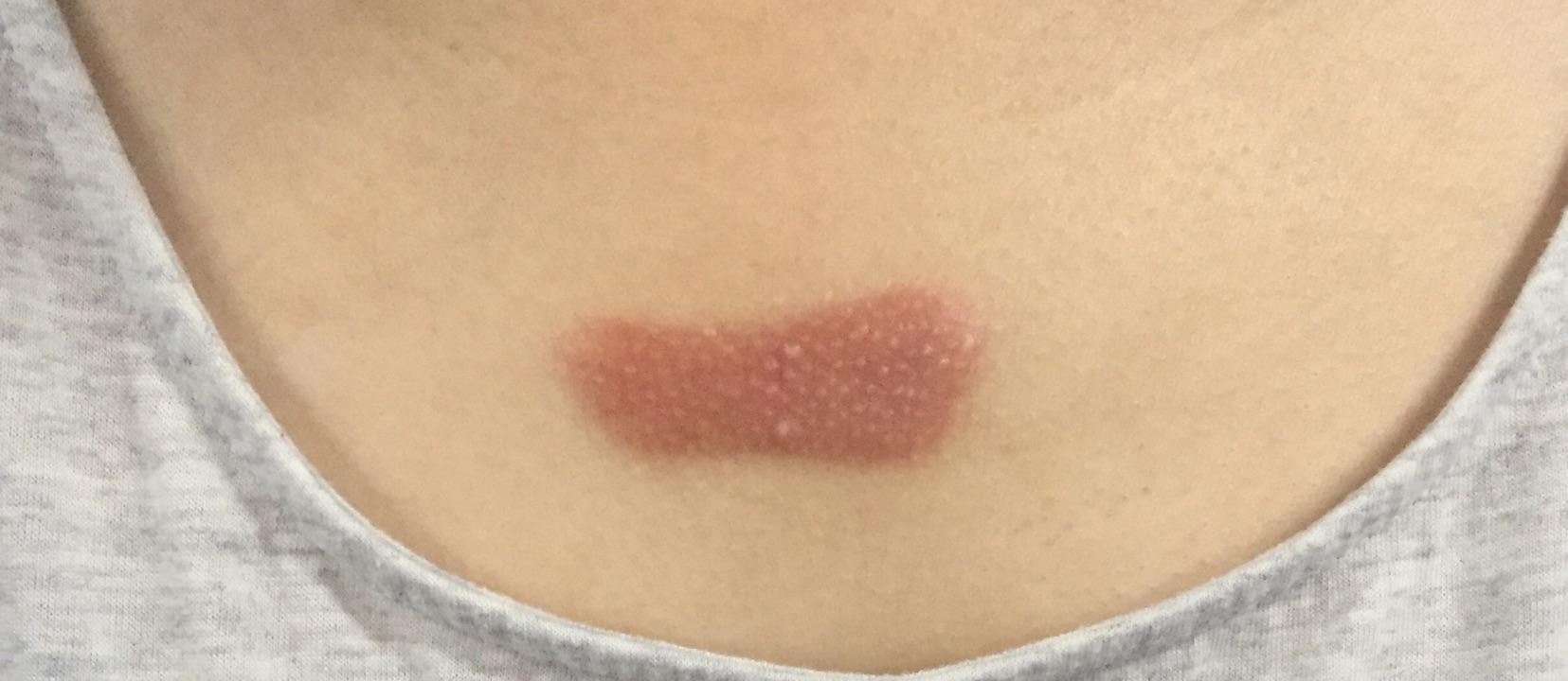 疤痕疙瘩到底怎么治能不能治好自己胸前长了一个增长速度越来越快应该