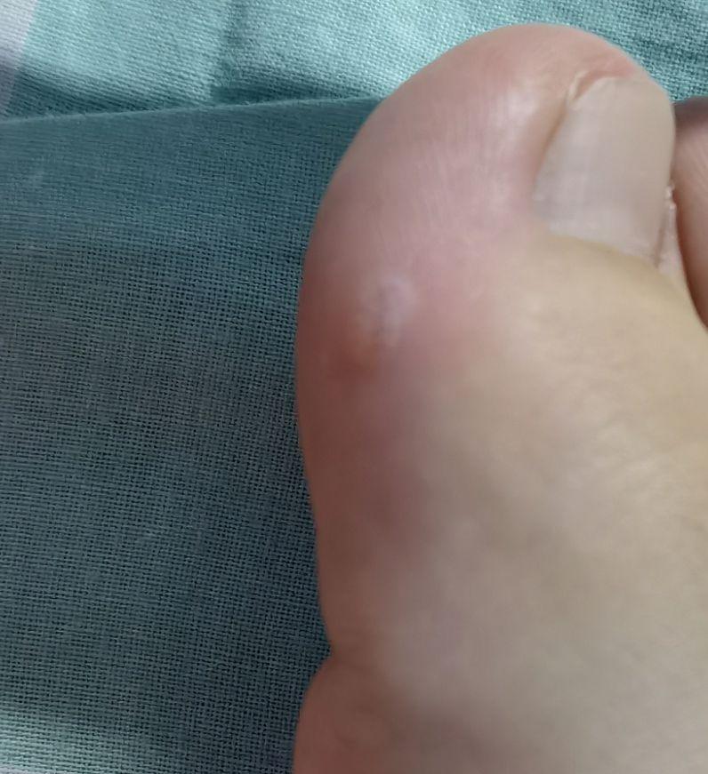 脚上磨出水泡该怎么办? - 知乎