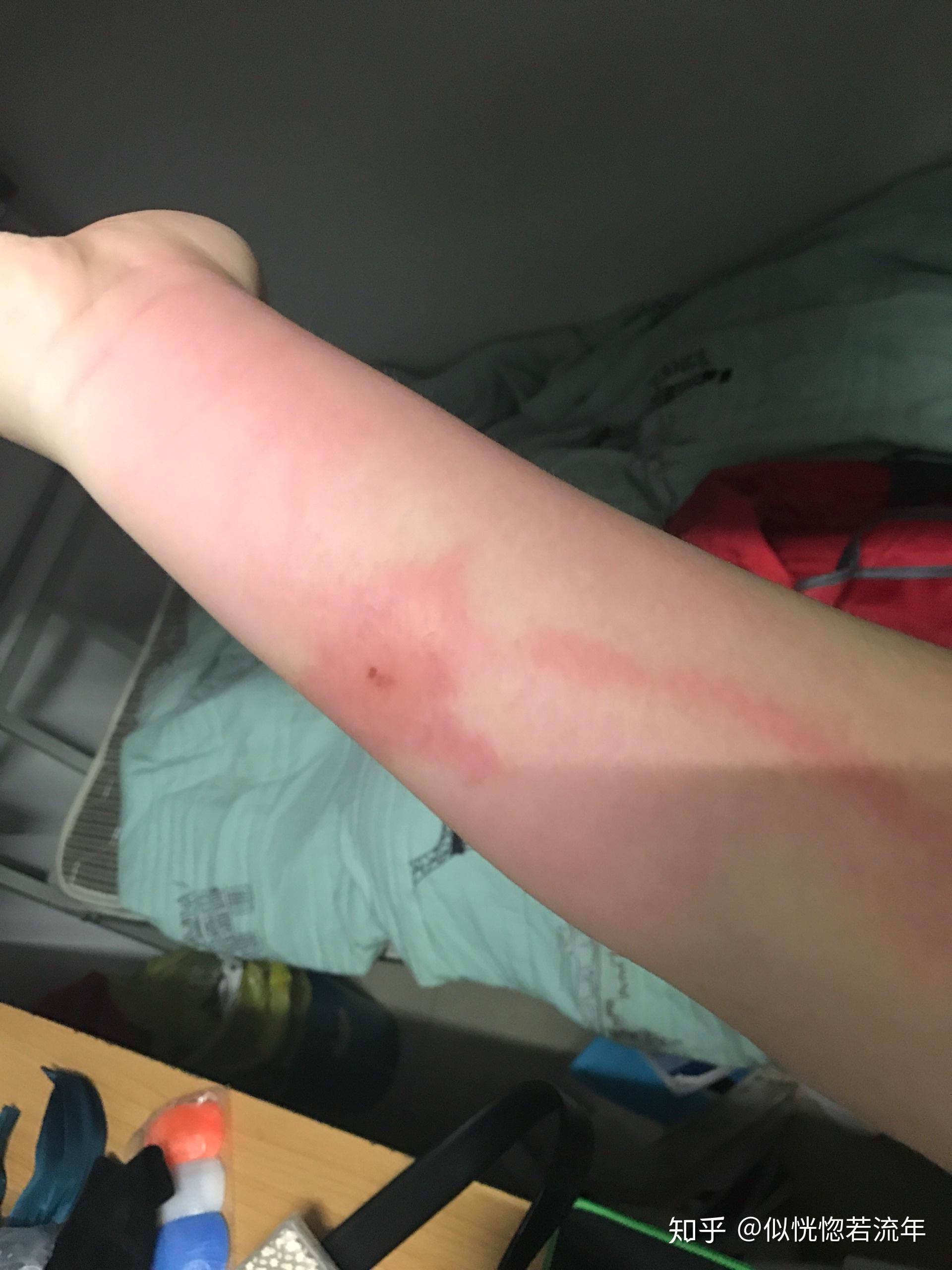 被虫子咬了胳膊上一条红线往上延伸这是什么