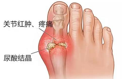痛风高尿酸该多运动还是多休息?5个运动建议，助你降尿酸防痛风- 知乎
