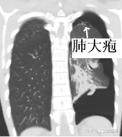 突发胸痛、呼吸困难、气促，尤其是年轻人，要警惕这个病——自发性气胸！！ - 知乎