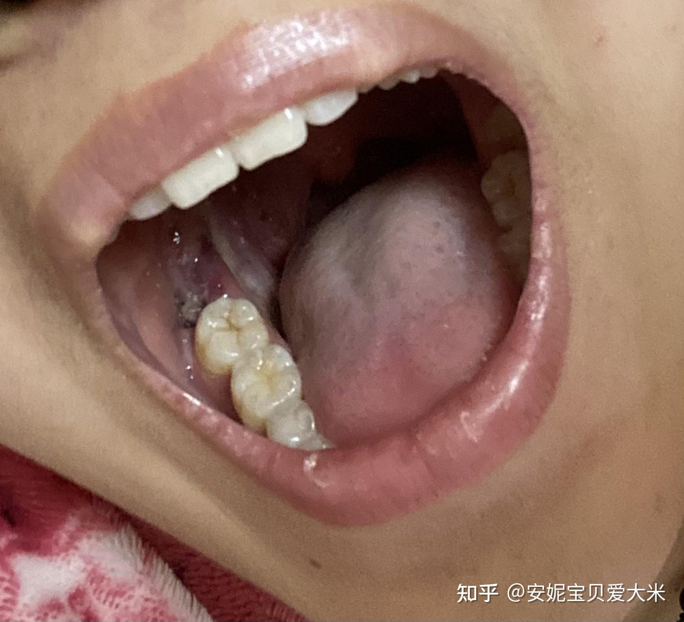 有一颗智齿一半长出来了一半在肉里位置正要拔吗