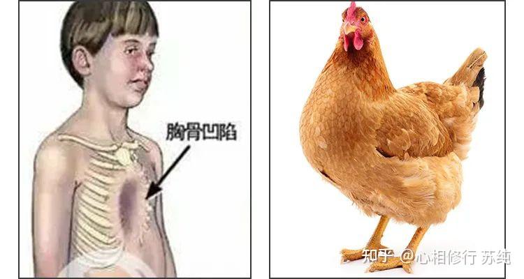 男人鸡胸驼背的命运图片